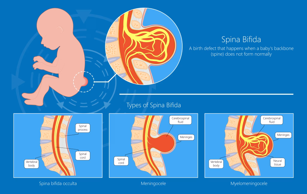 Medical illustration showing myelomeningocele (spina bifida) with exposed spinal cord and sac